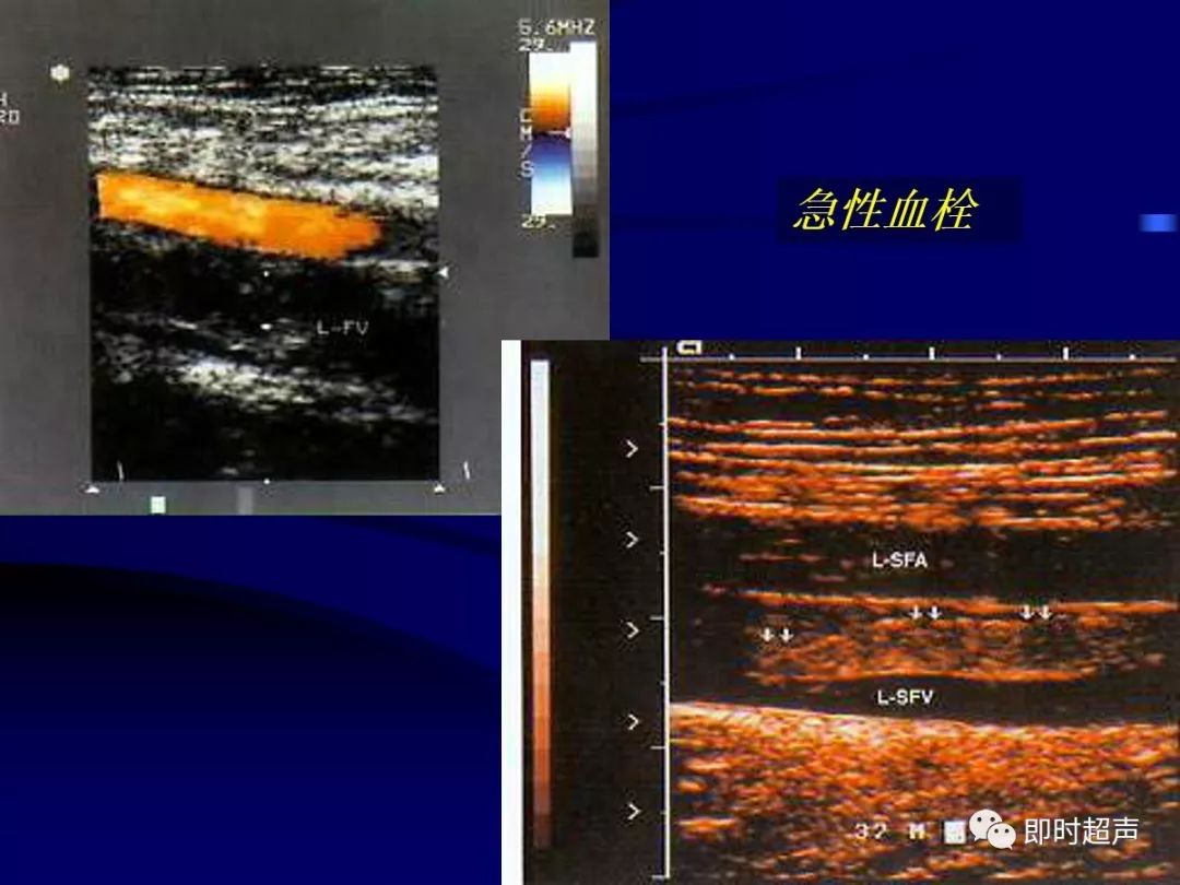 动静脉瘘● 病因先天性外伤(包括医源性)● 病理动脉血流从不正常孔道