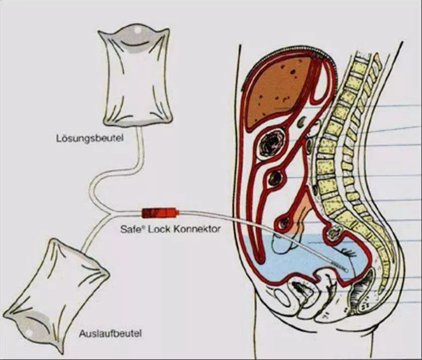 腹膜透析置管位置图片