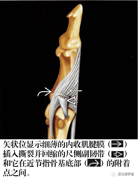 是由stener医生在1962年提出,定义是拇指掌指关节尺侧副韧带完全断裂