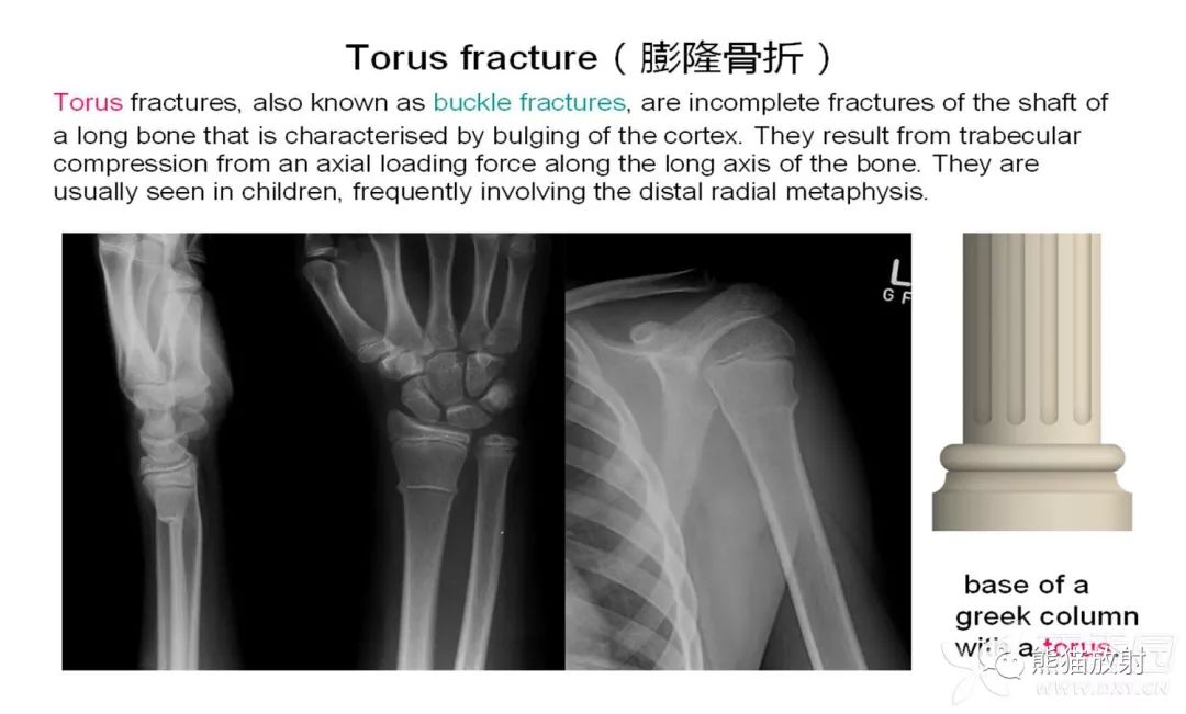 骨关节外伤丨特殊征象及名称 皮质