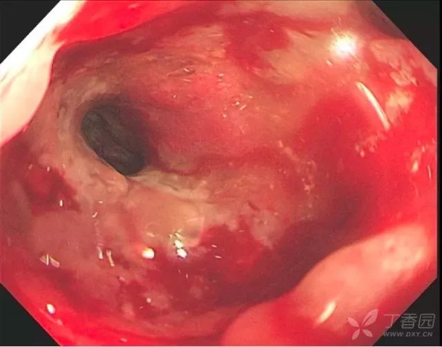 1例意外发现的直肠癌如何才能够早期发现