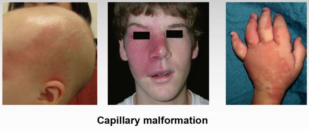 先天性毛细血管畸形图片