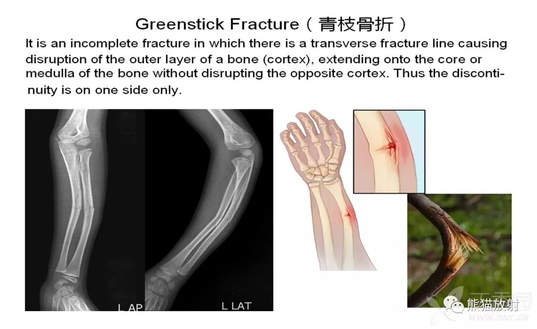 骨关节外伤丨特殊征象及名称 皮质