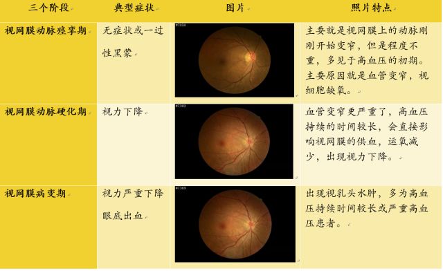 注意,高血压还能引起眼部疾病,严重可致失明!_病变