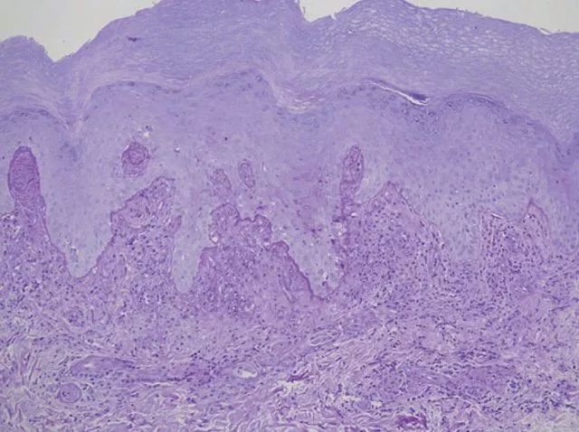 反向型 Gottron 征,你注意过吗?-搜狐大视野-搜狐新闻