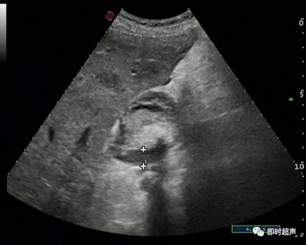 如:慢性胆囊炎,腺肌增生症,良性腺瘤,息肉等