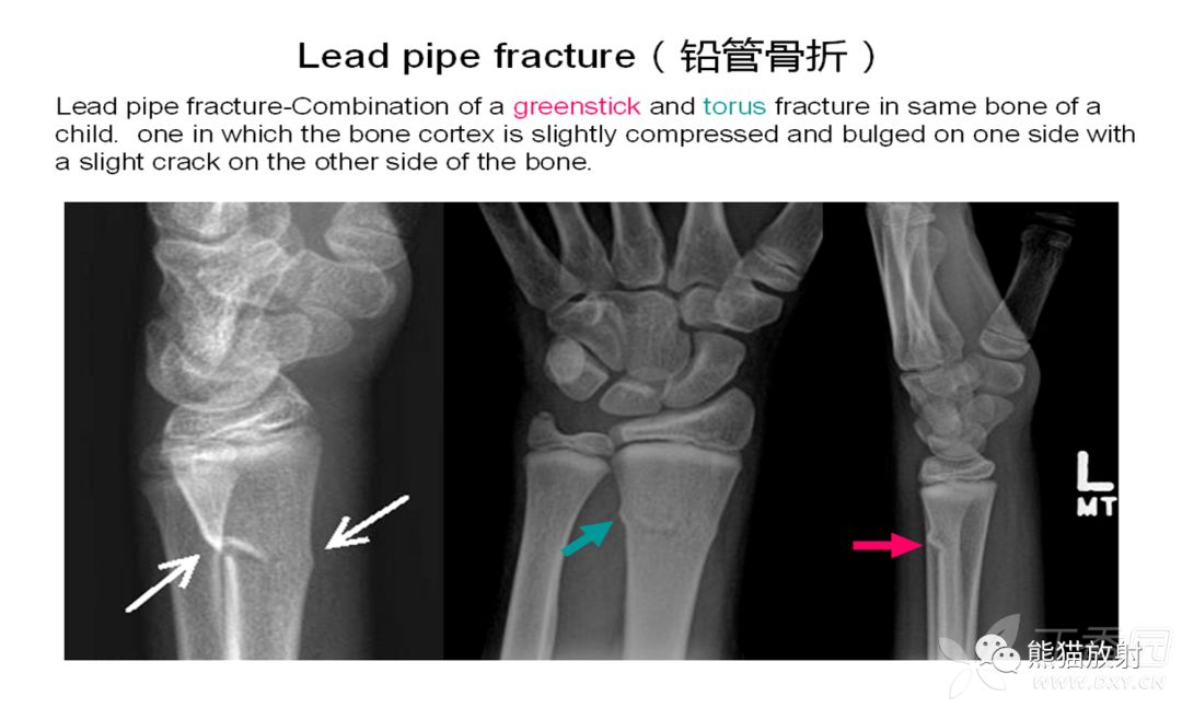 骨关节外伤丨特殊征象及名称 皮质