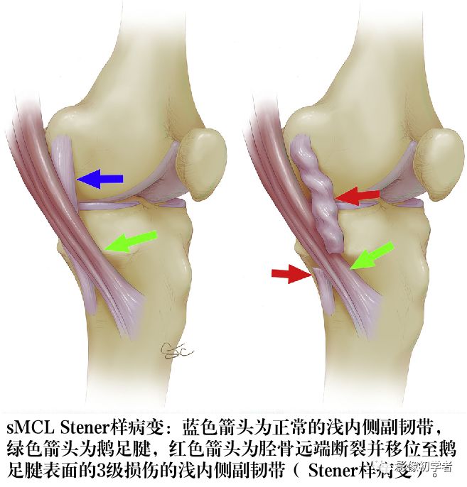 膝关节内侧副韧带损伤二