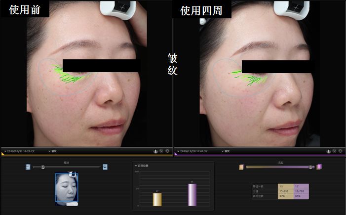使用四周,通过美国visia皮肤分析仪记录,使用面膜四周法令纹减轻,表明