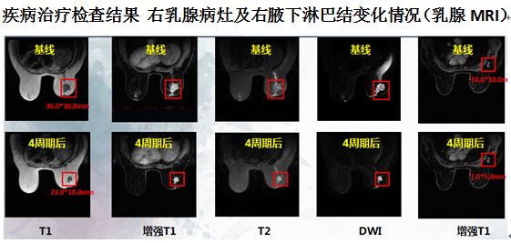 晚期乳腺癌内分泌诊疗病例精选绝经后hrher2晚期乳腺癌肺转移1例