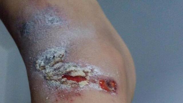 骨折都出血啦却不能马上做手术宝宝妈妈着急坏了