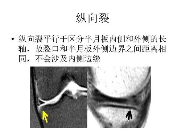 半月板的影像学表现