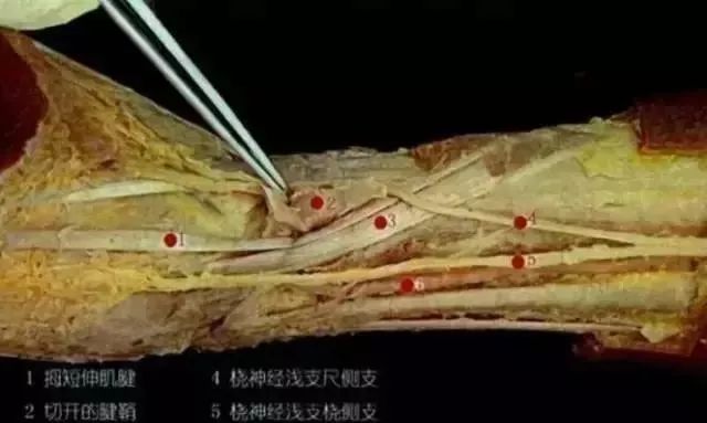 腱鞘炎松解术手术图解图片