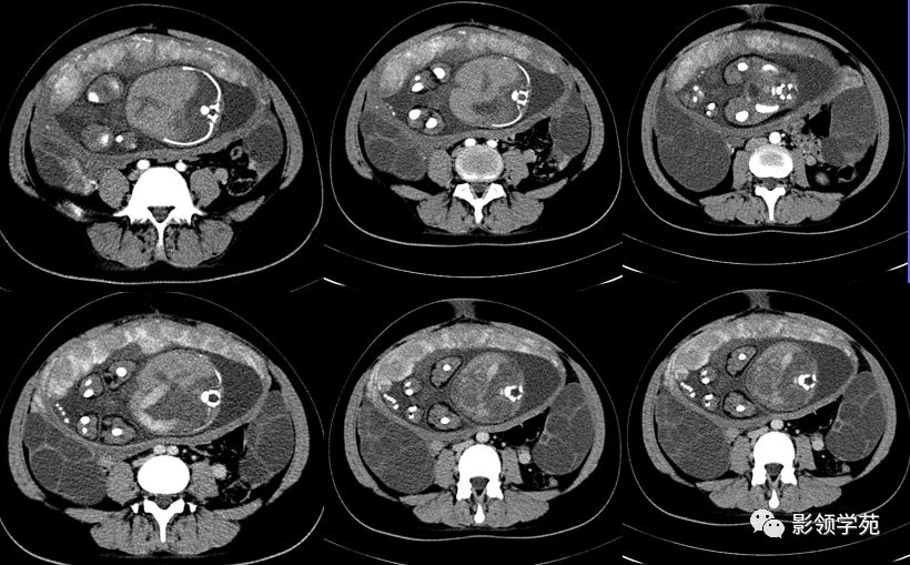 卵巢良性病变及子宫病变的影像诊断