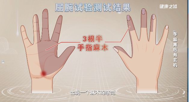 容易导致肌腱滑膜增生挤到正中神经,造成手部劳损,更容易得腕管综合征