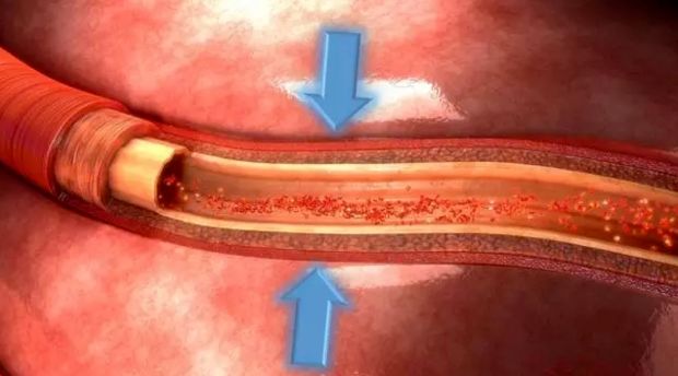 冬季,天气寒冷,易导致血管收缩,造成血压上升,脑血管也容易发生痉挛