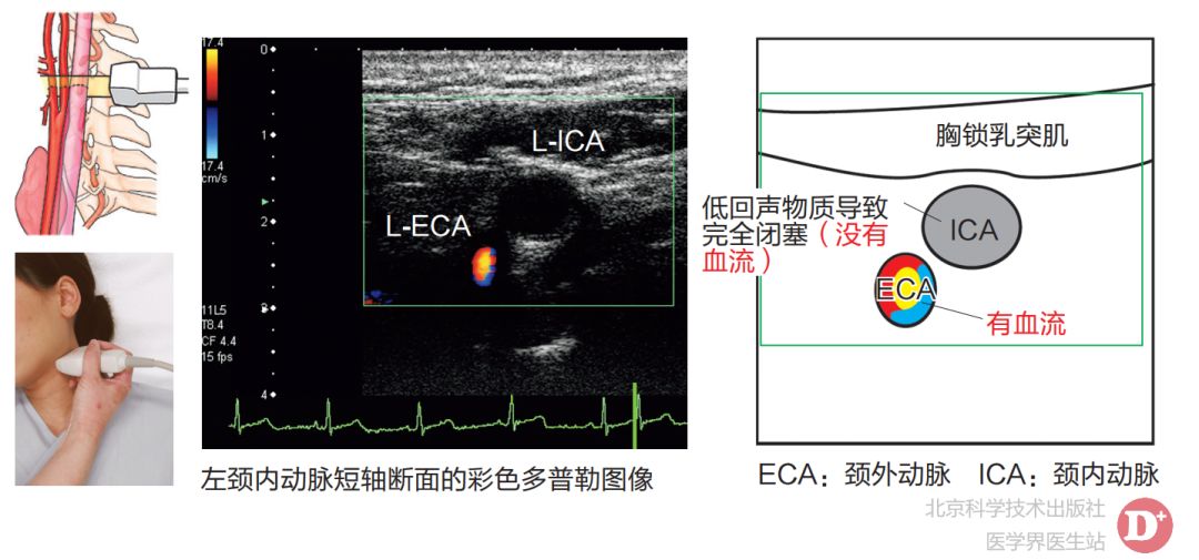 一文掌握颈内动脉闭塞的超声诊断