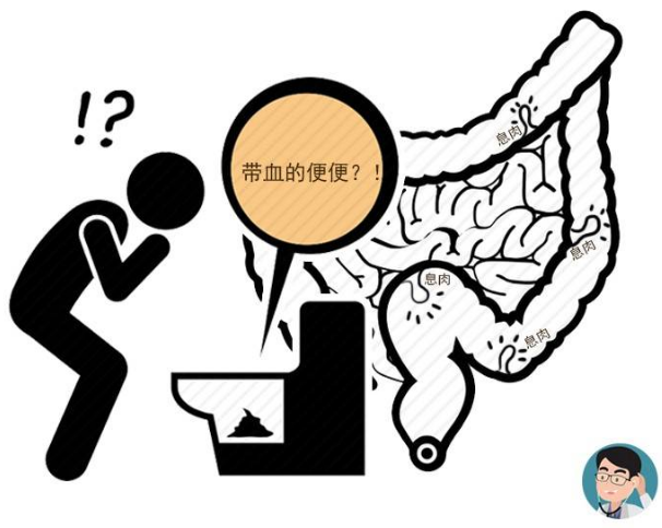 腸內有癌,大便先知?若排便時出現這4種現象,暗示腸癌已到來!