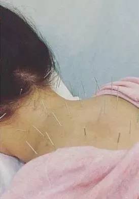 上个月因过敏导致全身泛红起疹子,本月初更是在肩颈部扎了25 针做针灸