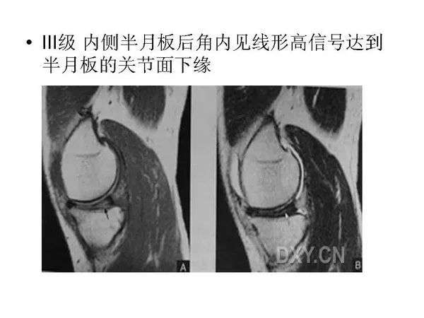 半月板的影像学表现