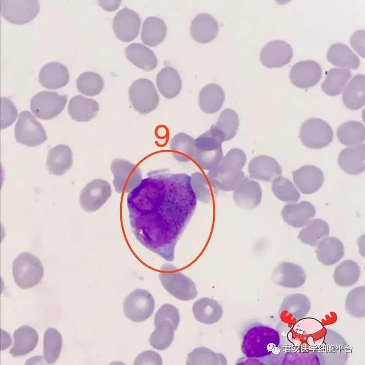 ▼「异常早幼粒细胞」形态特征:胞体较大,呈圆形或类圆形, 内质外浆