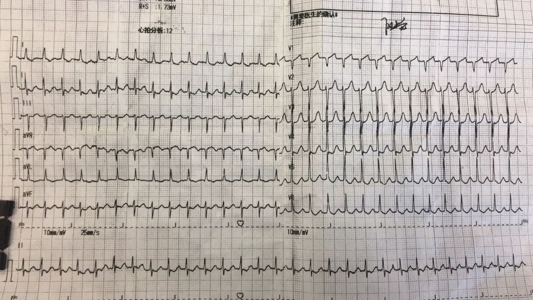 心电图识图