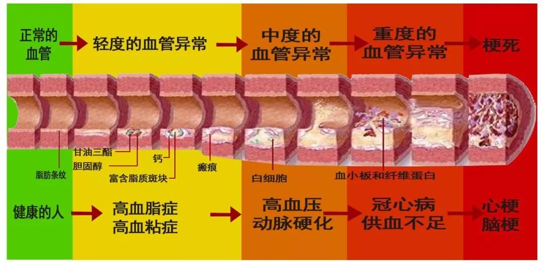 心梗腦梗腦出血這些發病先兆急救要點千萬要知道