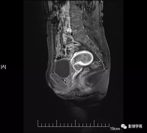 阴道出血发现宫腔占位子宫内膜癌