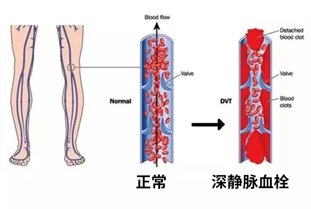 下肢静脉血栓解剖图图片