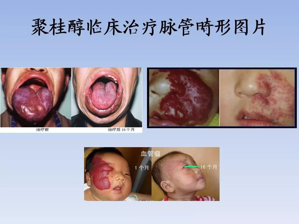 教学ppt血管瘤脉管畸形的聚桂醇硬化治疗