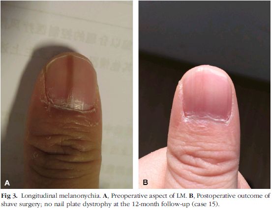 改良薄层切削法联合甲板开窗术治疗纵行黑甲67例疗效评价