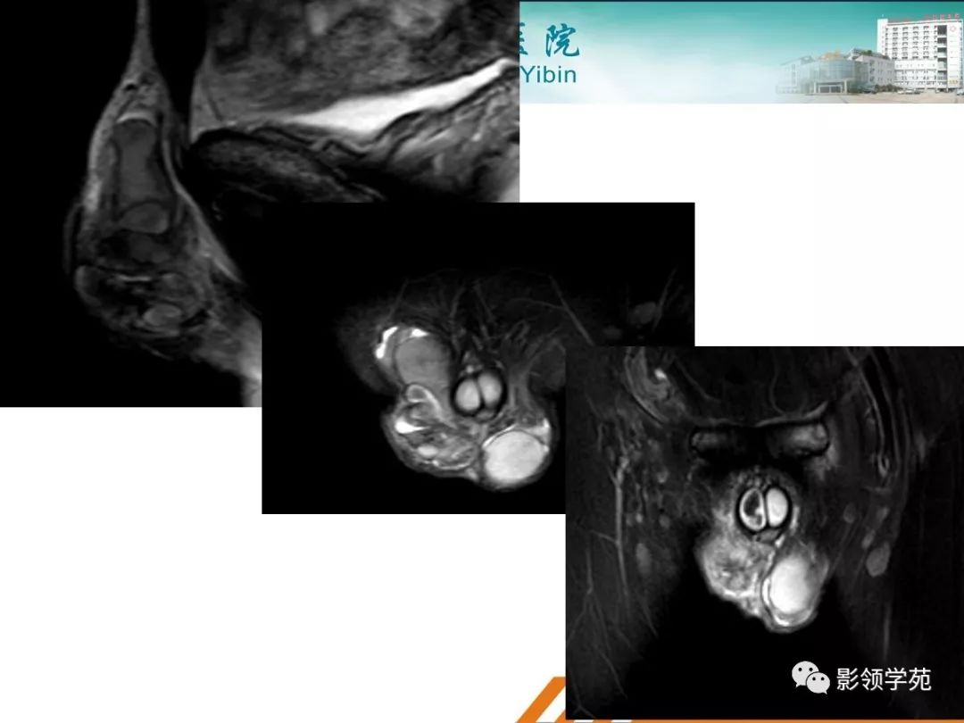 睪丸疾病mr診斷