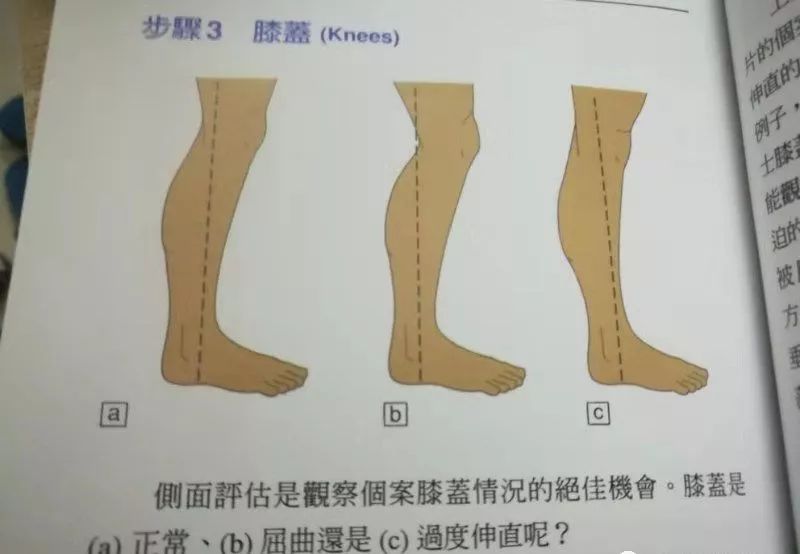 警惕卒中後出現膝過伸讓康復之路又艱難一步