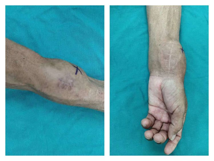 普洱市人民医院骨科成功完成首例3d打印腕关节置换术