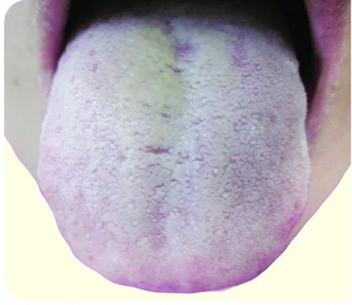 从舌看湿气 ,祛湿有妙法! 对照看看,您是否湿气严重!