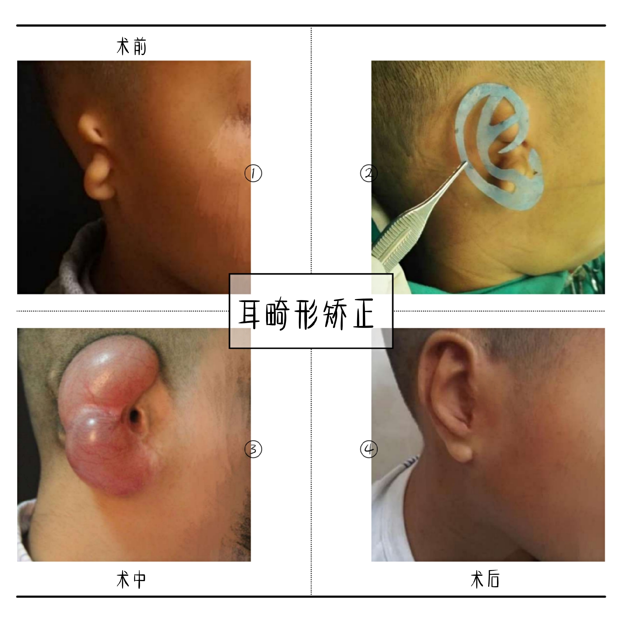 先天性耳朵畸形治疗图片
