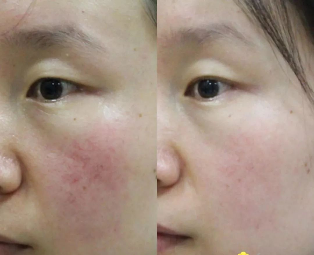 光子嫩肤让您的肌肤越变越美