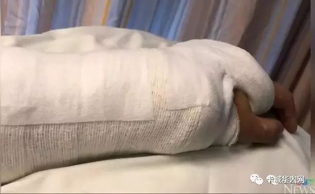 小哥车祸手臂断了结果医院痛了6天才等到手术