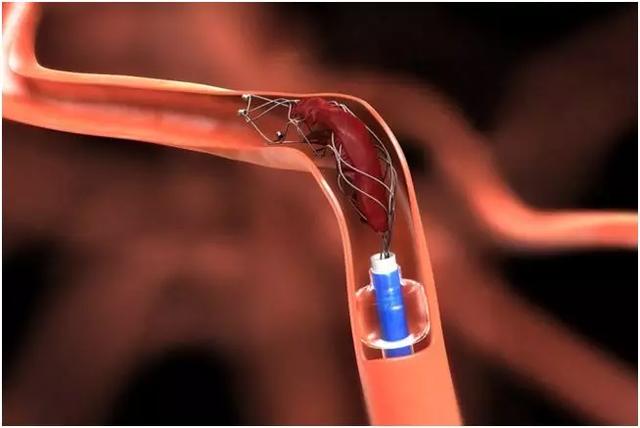 机械取栓新产品登陆中国市场