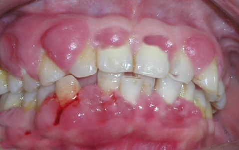 牙医需看如何做好艾滋病风险预防