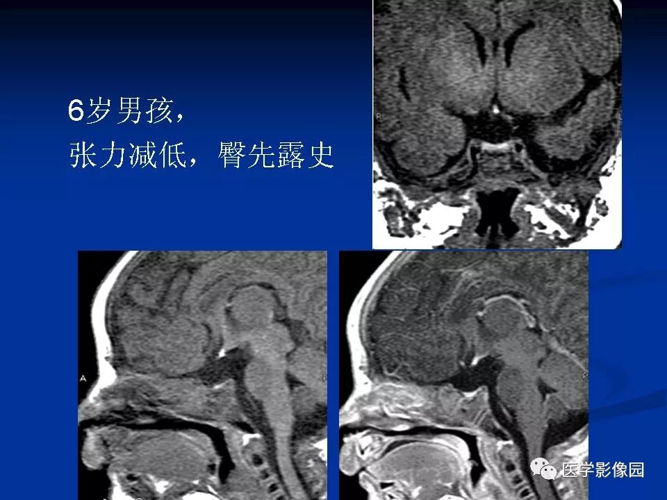 垂体柄阻断图片