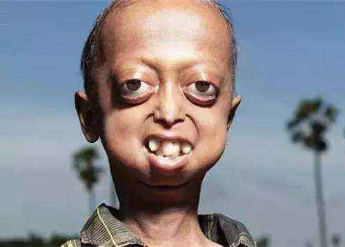 早衰症又称儿童早老症是一种先天遗传性疾病,患上这种疾病的儿童身体