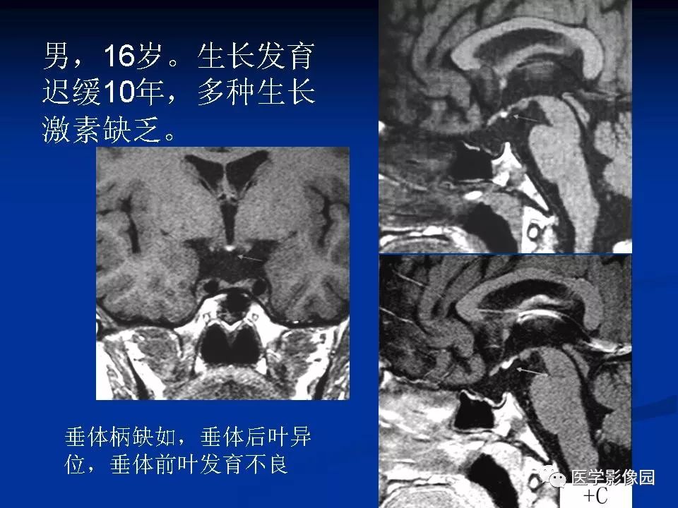 垂体柄阻断综合征的mri诊断