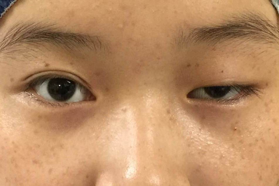 原创 卢丙仑教授:眼睛睁不大就像没睡醒,能做双眼皮吗?