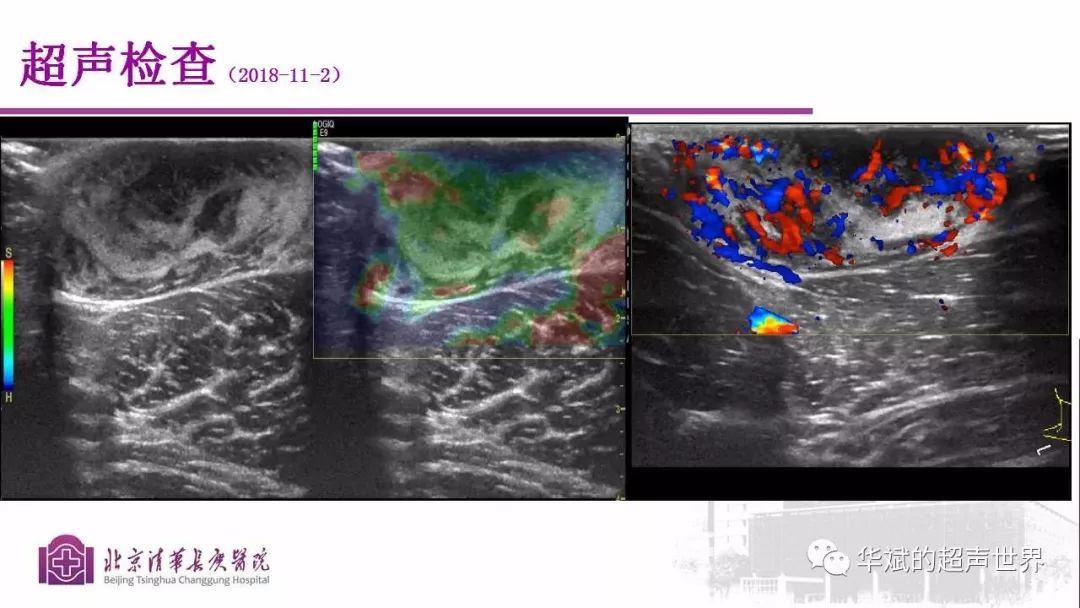 皮下纤维瘤超声声像图图片