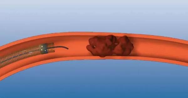 机械取栓新产品登陆中国市场