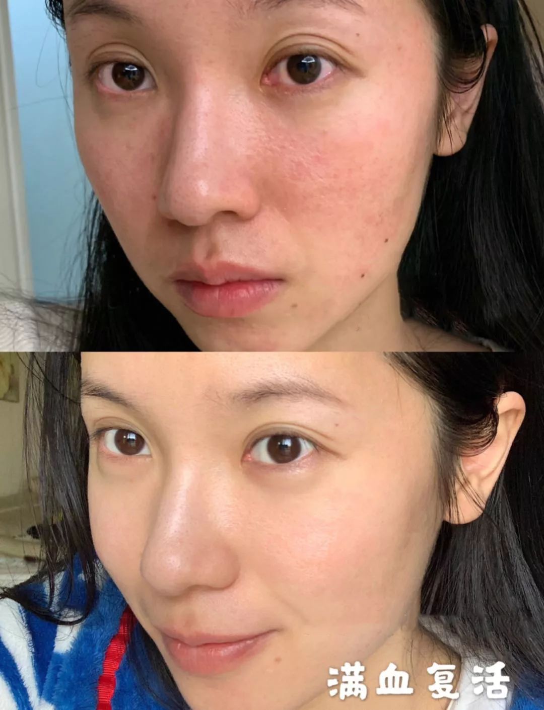 反复长痘?这份经万人试验的祛痘秘籍,建议保存收藏