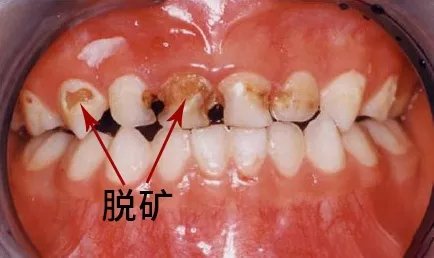 牙齿脱矿症状图片