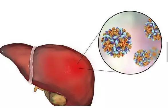 肝病專家特別強調,臨床觀察中發現,無症狀乙肝病毒攜帶者轉肝癌的幾率