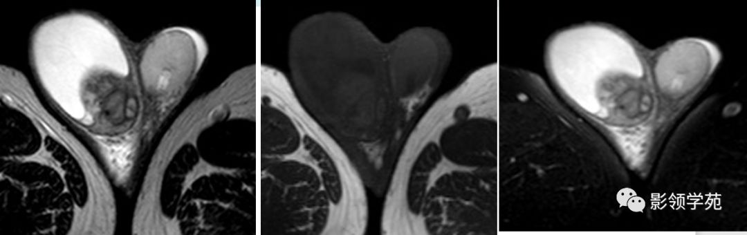 睪丸疾病mr診斷